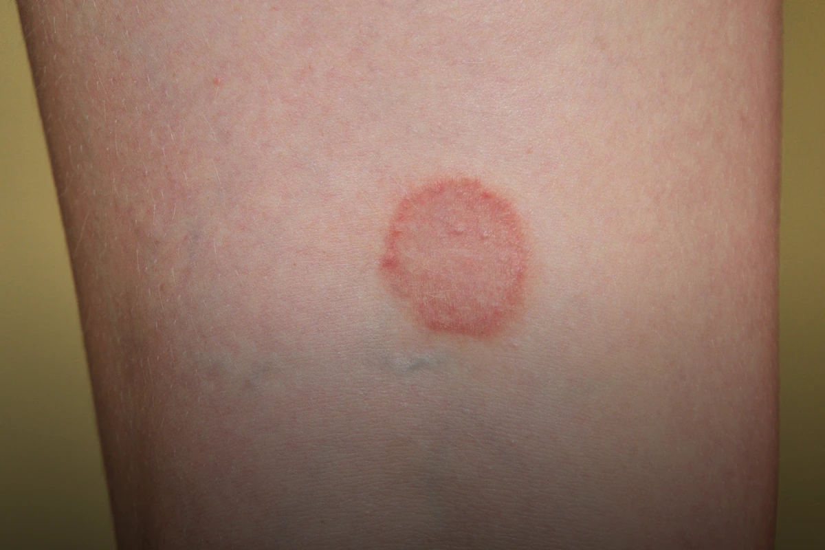 Fungal infections such as Ringworm and Tinea on skin
